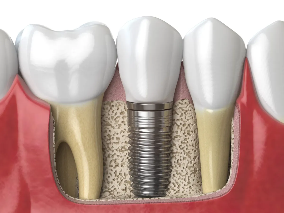 Ilustratie cu un implant dentar fixat in os intre doi dinti naturali