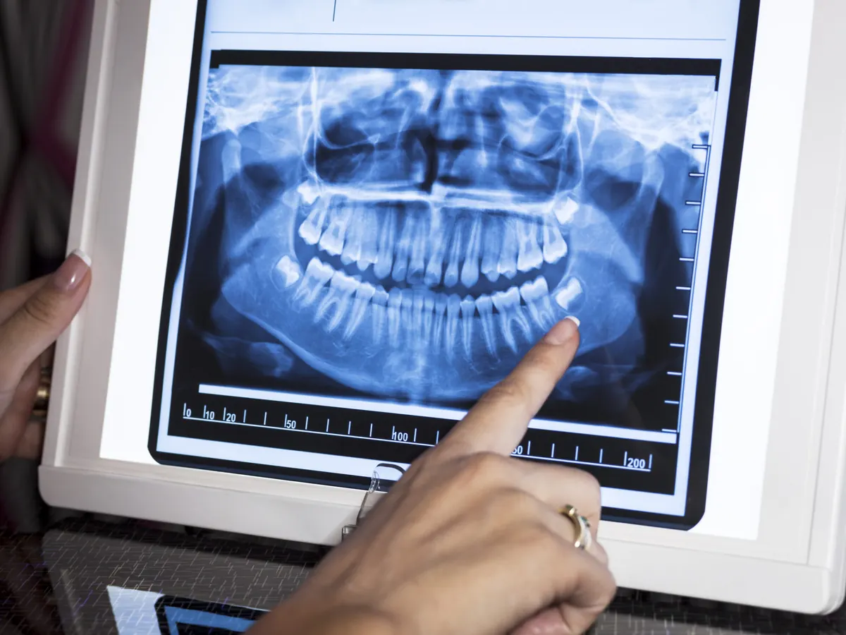 Radiografie panoramica dentara afisata pe un ecran